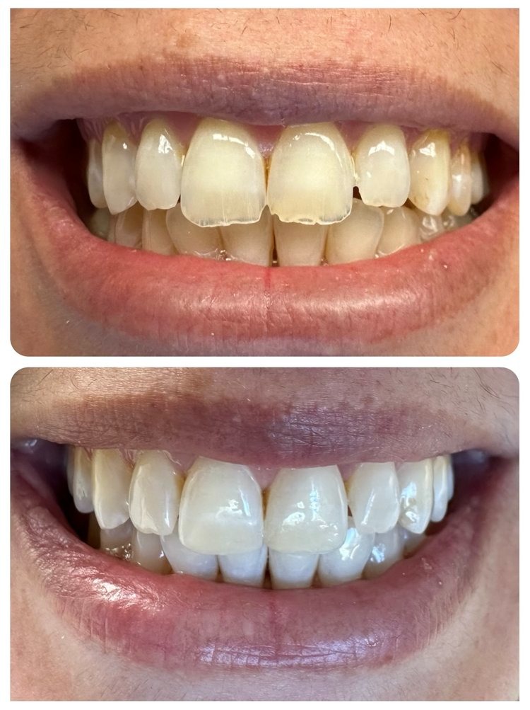 Composite Bonding and Teeth Whitening by Dr Syal