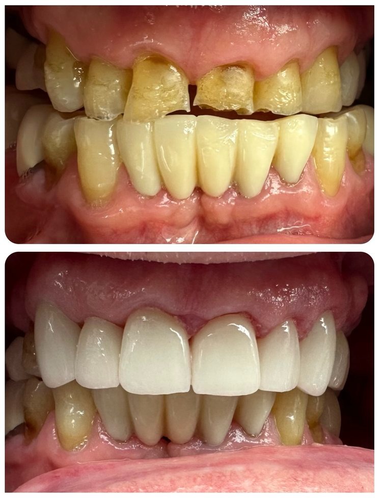 Cosmetic Crowns by Dr Syal