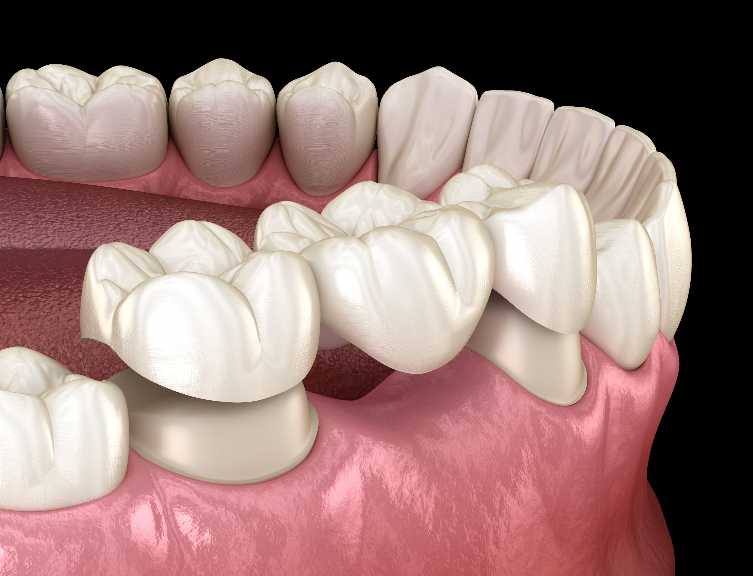 Dental Bridges in Santa Rosa