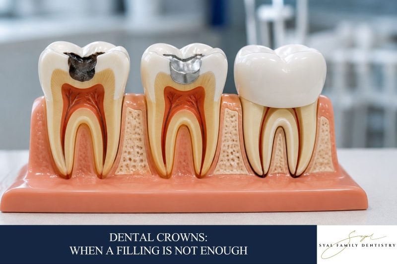 Dental Crowns: When a Filling Is Not Enough